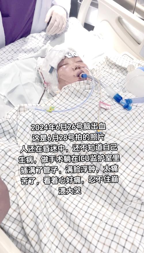 大面积脑梗第7天死亡