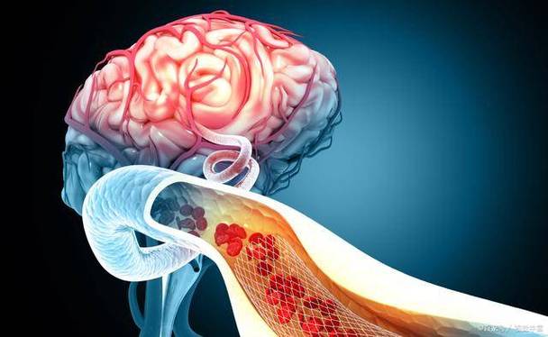 达比加群会引起脑梗吗