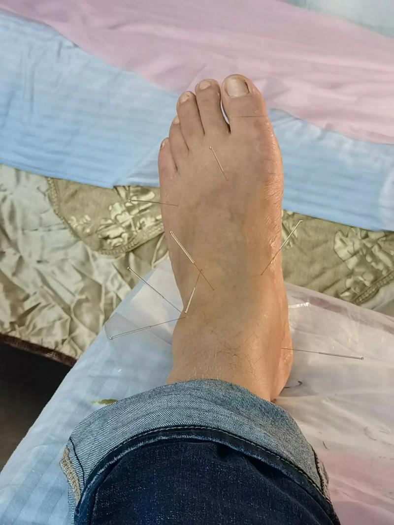 程凯讲腿风湿经络刺血