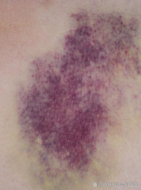 膝盖拔罐后紫是风湿吗