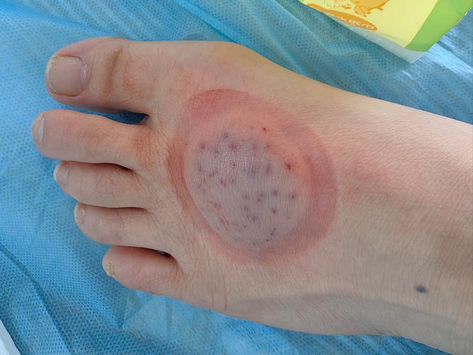 膝盖拔罐后紫是风湿吗