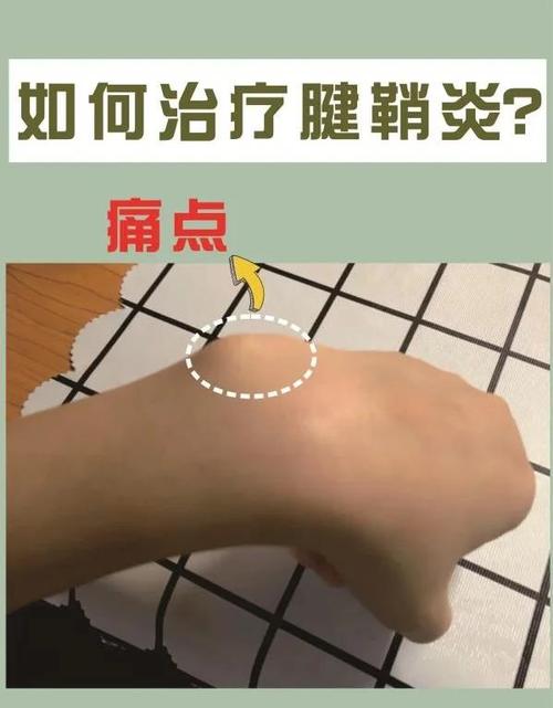 风湿病手腕痛怎么治疗