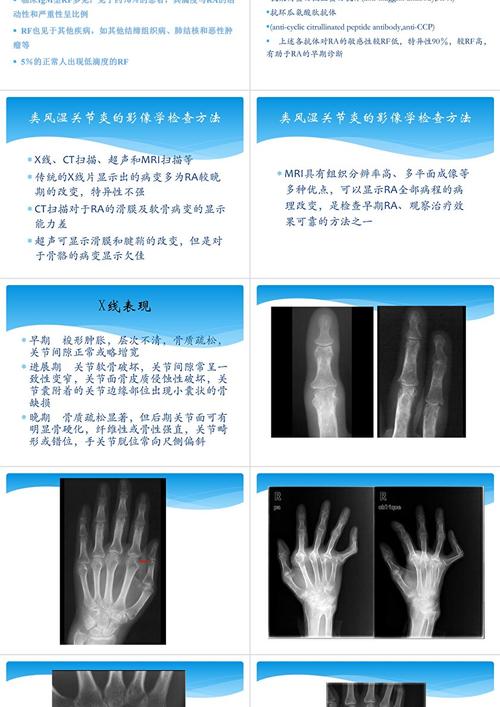 类风湿关节炎影像表现