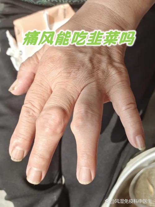 类风湿痛风能吃韭菜吗