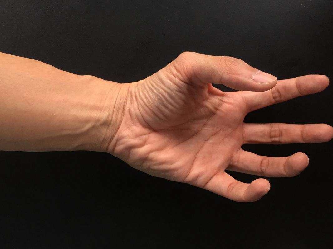 脑梗后恢复期间手臂疼