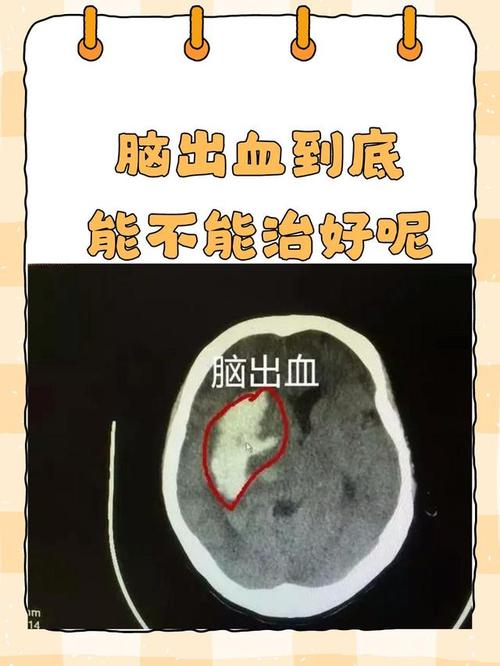 脑梗病人上消化道出血