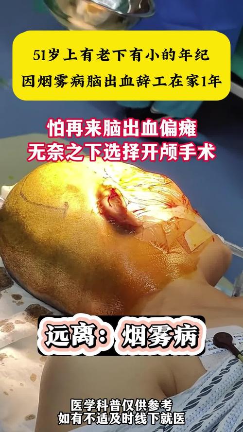 脑梗病人上消化道出血