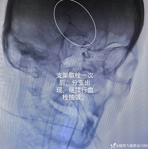 大连微针取血栓治脑梗