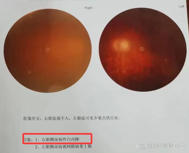 脑梗会引起眼睛重影吗