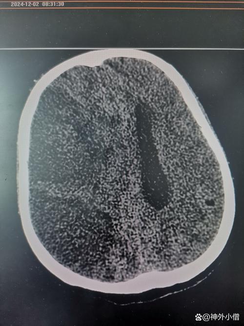 手术引发的大面积脑梗