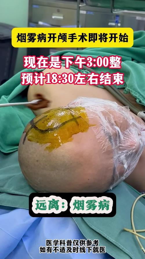 手术引发的大面积脑梗