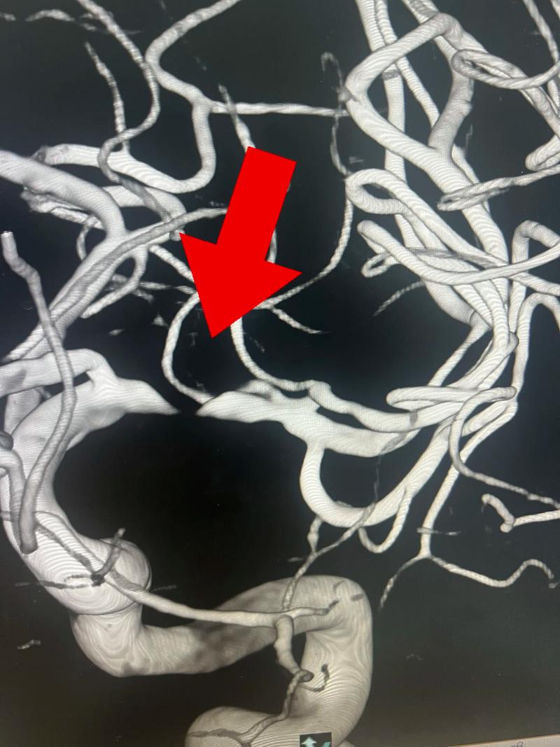 脑梗支架手术用开卢吗