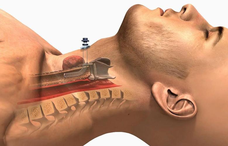 脑梗有痰用切开气管吗