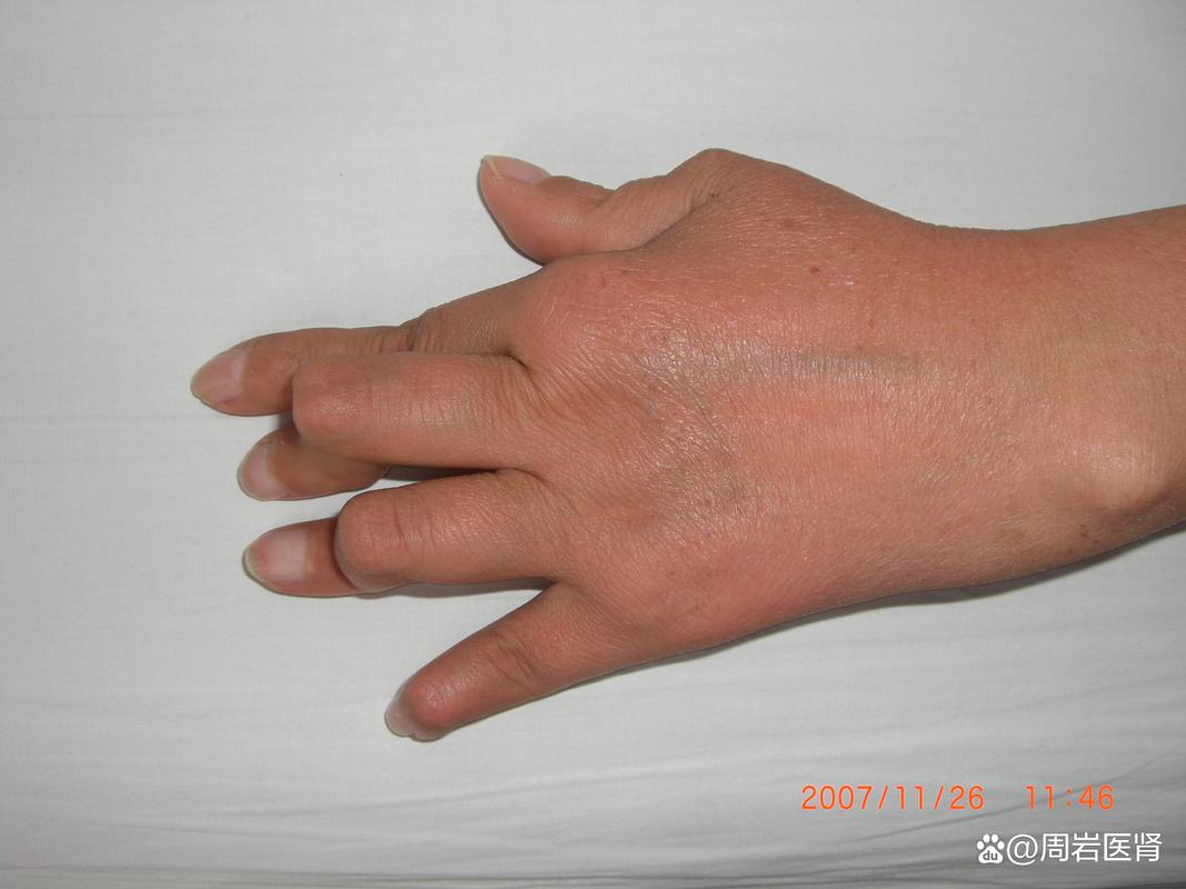 类风湿关节炎症状图片