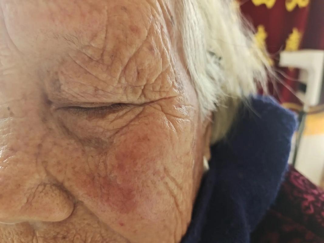 脑梗很多年后眼皮下垂