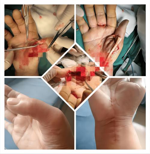 类风湿关节炎手指手术