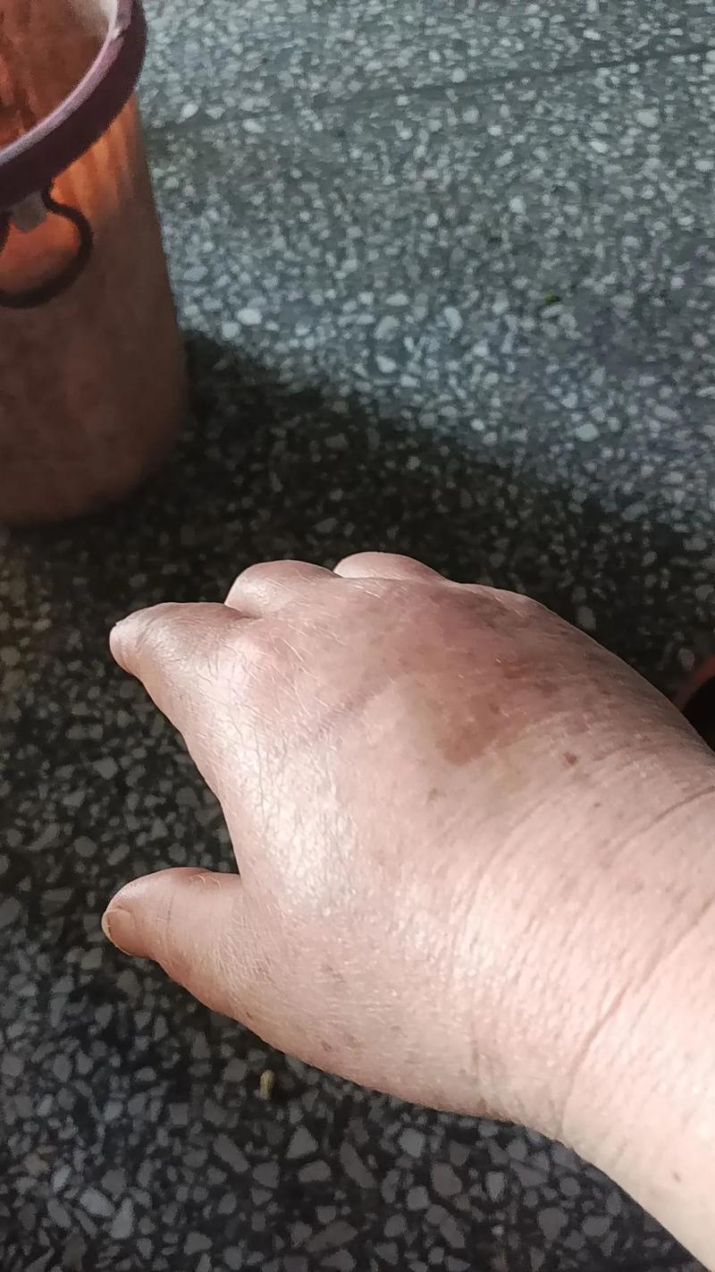 脑梗病人手肿怎么回事