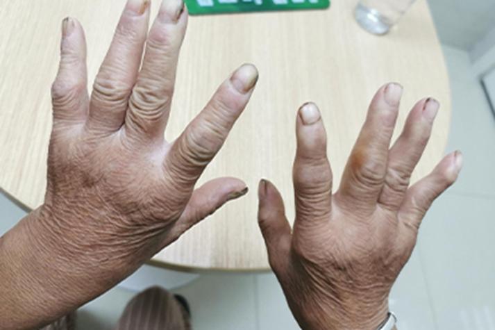 海南三亚关节炎 风湿