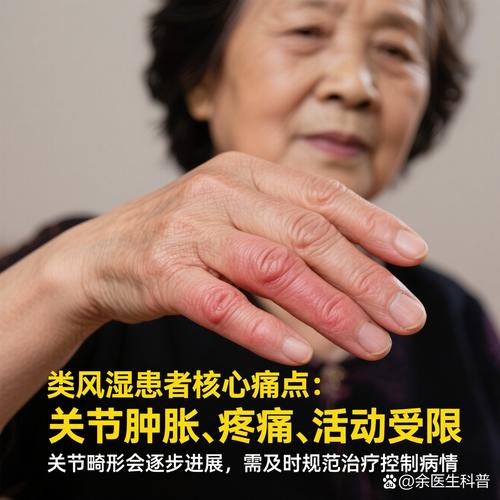 超短波能治疗类风湿吗