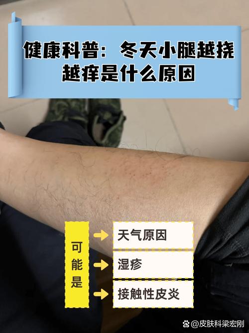 风湿病身上痒有关系吗