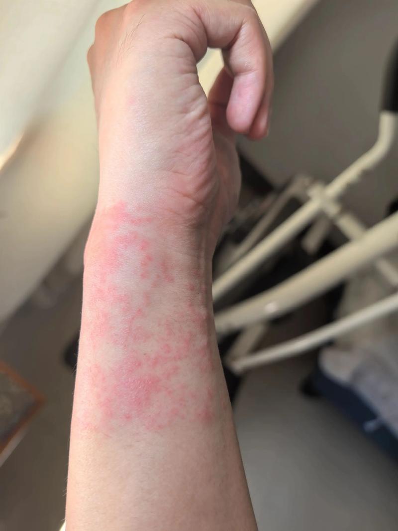 贴风湿贴过敏了怎么办