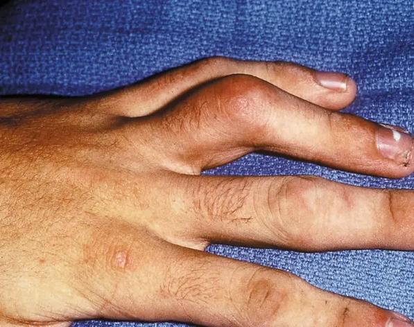 类风湿关节炎皮肤症状