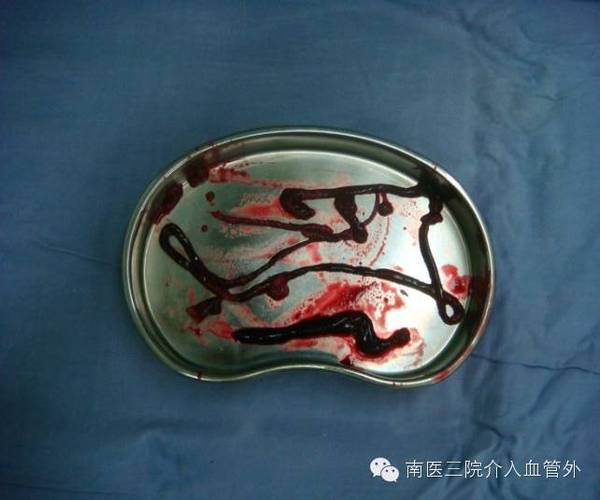 风湿性心脏病形成血栓