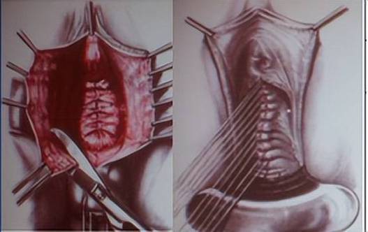 阴道松弛的穴位疗法