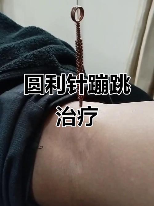 圆利针疗法治产后风湿