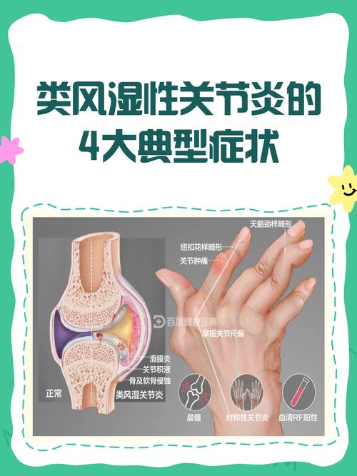 治疗类风湿关节炎症状