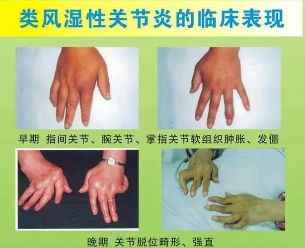 治疗类风湿关节炎症状
