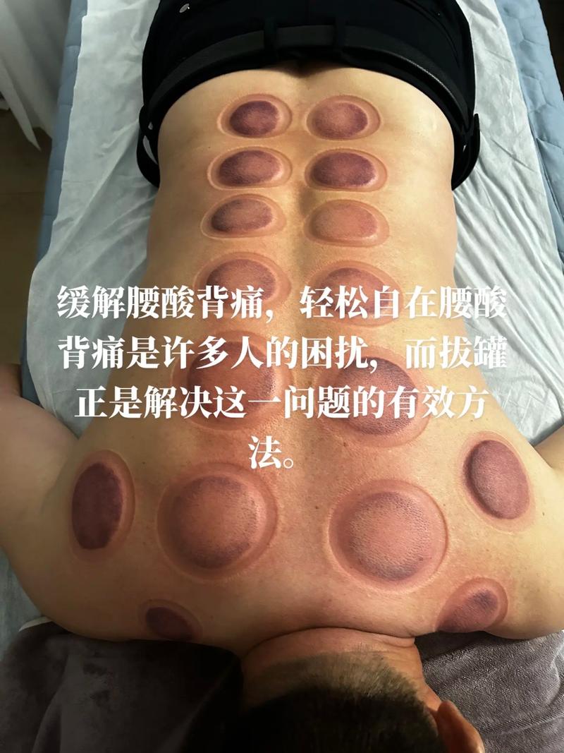 风湿在什么地方拔罐图