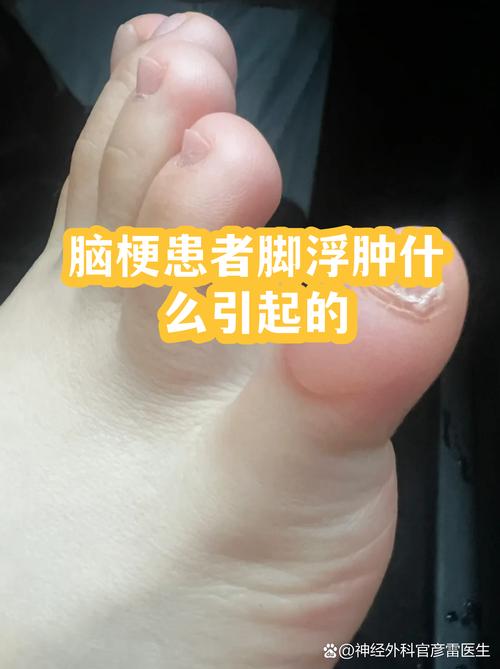脑梗瘫痪病人手脚浮肿