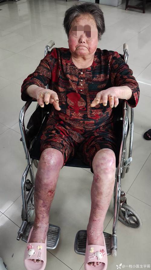 脑梗瘫痪病人手脚浮肿