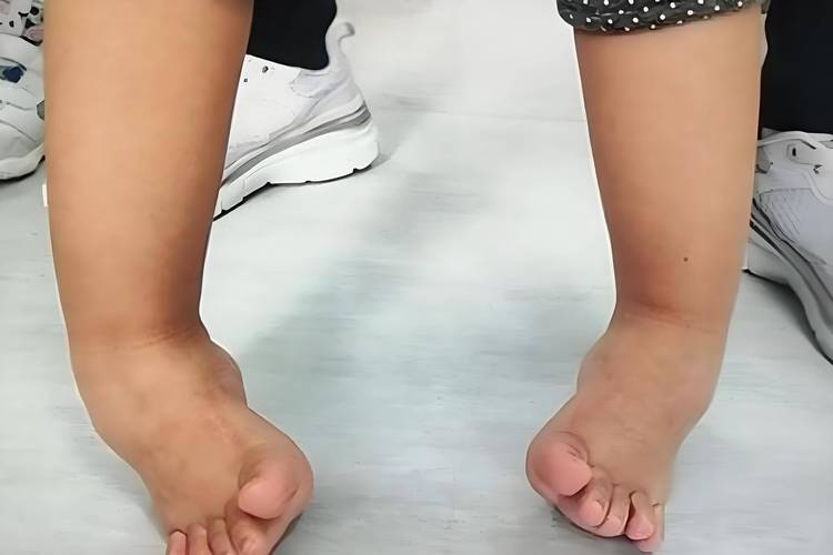 脑梗瘫痪病人手脚浮肿