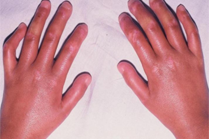 风湿病引起结缔组织病