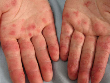 风湿病引起结缔组织病