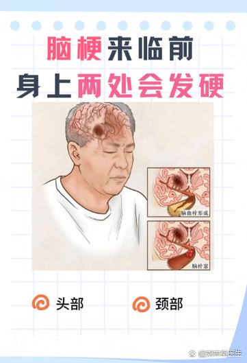 脑梗手抽搐是怎么回事