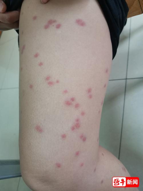 风湿病皮肤起红疙瘩吗