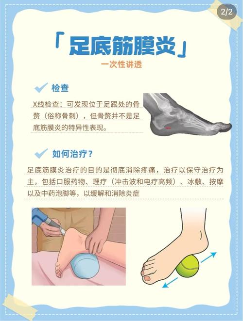 风湿性筋膜炎怎么治疗