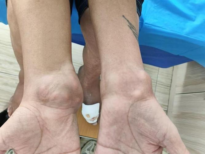 风湿关节炎能吃海鲜吗