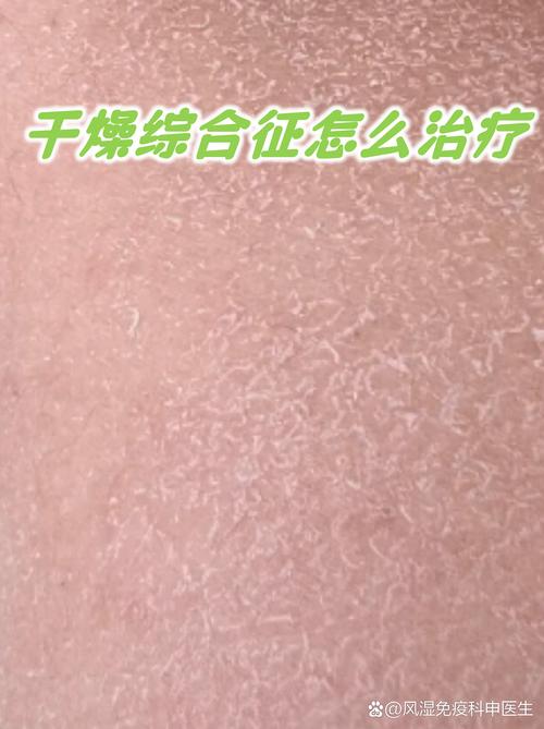 风湿干燥综合征怎么治