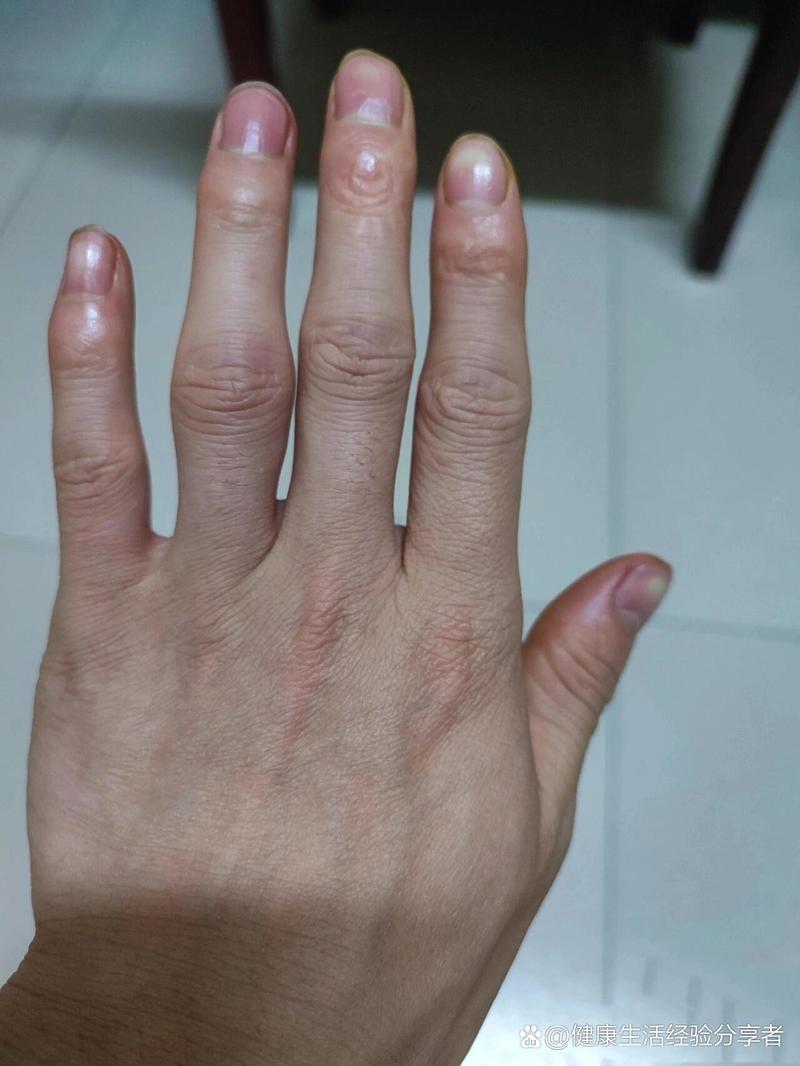 类风湿关节炎手部畸形