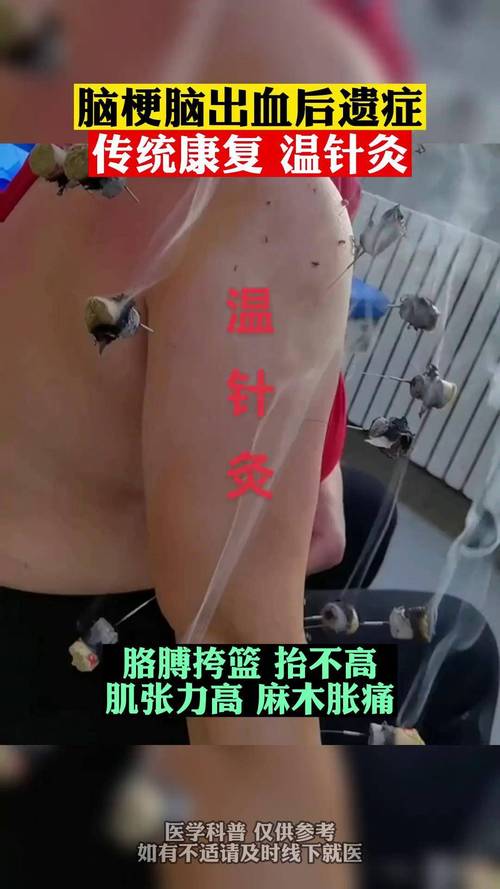 脑梗后遗症的艾灸疗法