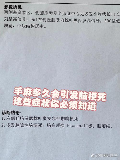 脑梗引起的手麻严重吗