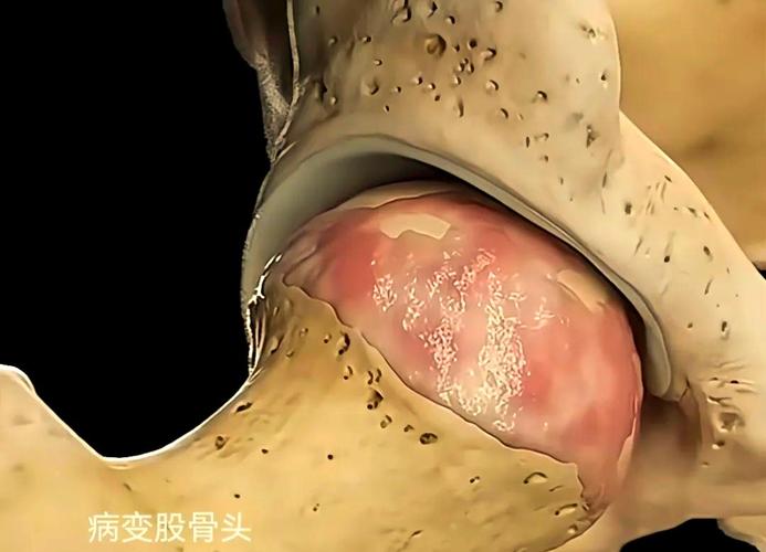 类风湿引起股骨头坏死