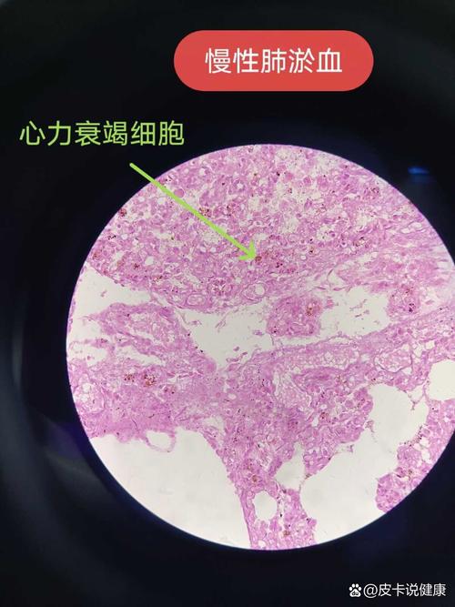 风湿性心肌炎病理图片