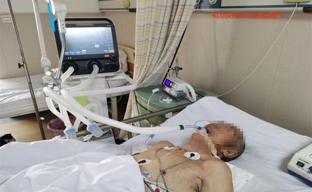 重症病房脑梗上呼吸机