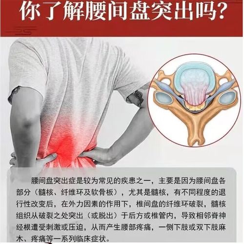 腰风湿痛用什么药最好