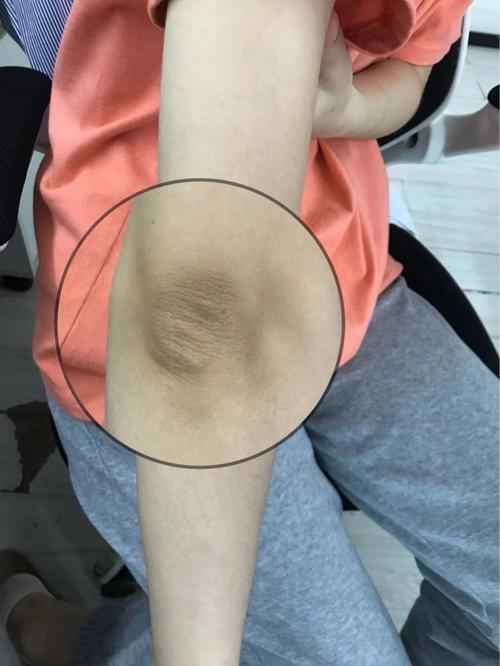 膝盖黑会不会是有风湿